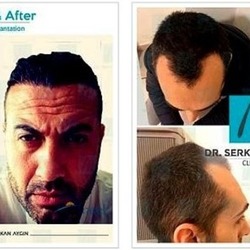   Иновационная клиника где можно заказать пересадку волос: Trasplante Capilar en Turquia